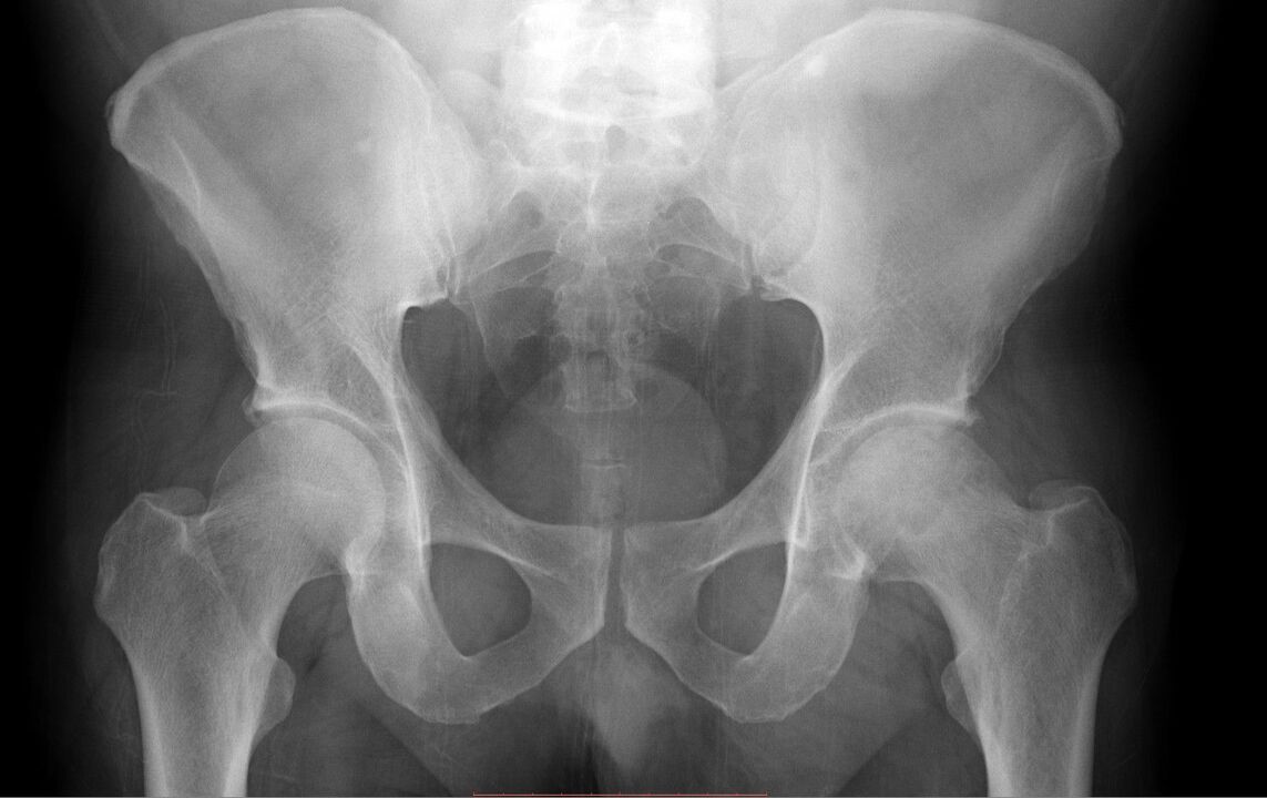 diagnostic de l'articulation de la hanche