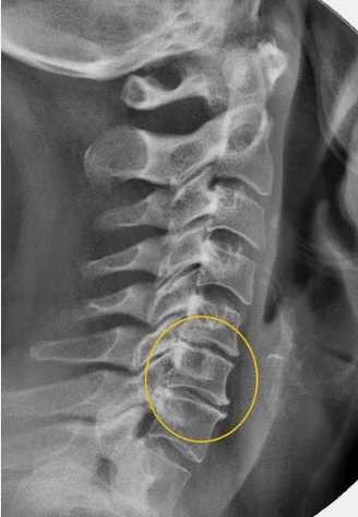 Ostéochondrose de la colonne cervicale sur un rayon x
