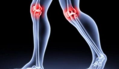 Prévention du développement de l'arthrite et de l'arthrose