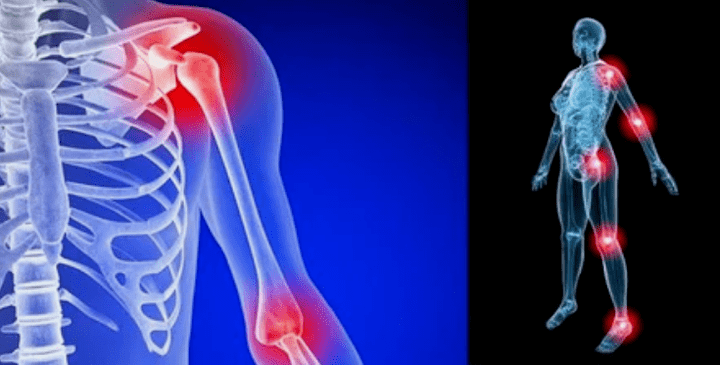 Limitation des membres de l'arthrose