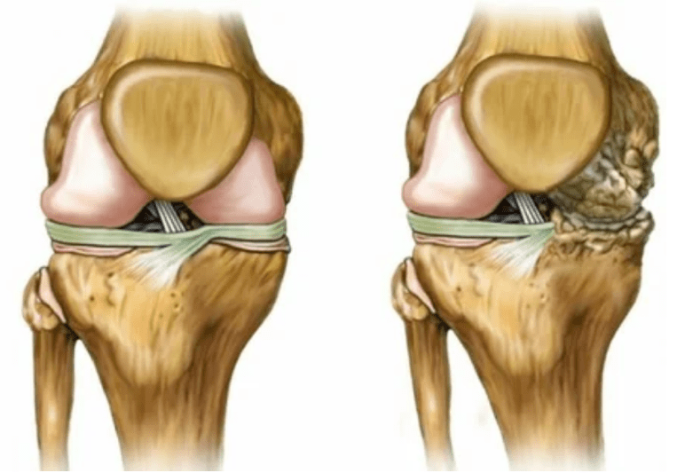 Stades d'arthrose