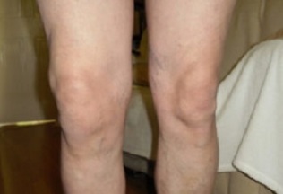 Manifestations d'arthrose de l'articulation du genou (1)