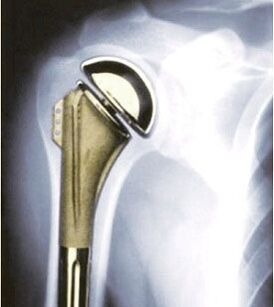 Arthroplastie de l'épaule pour l'arthrose