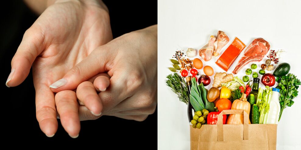 Arthrite goutteuse des mains et aliments pour leur traitement