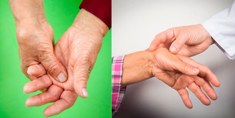 L'enflure et la douleur sont les premiers signes de l'arthrose de la main