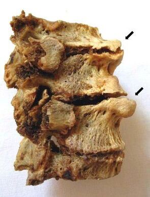 Section des vertèbres affectées par l'ostéochondrose