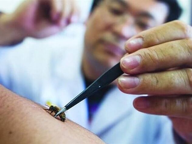 Apithérapie pour l'ostéochondrose cervicale