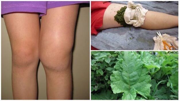 Compresse à base de plantes pour l'arthrose du genou