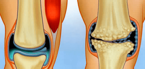 Articulation et arthrose normales